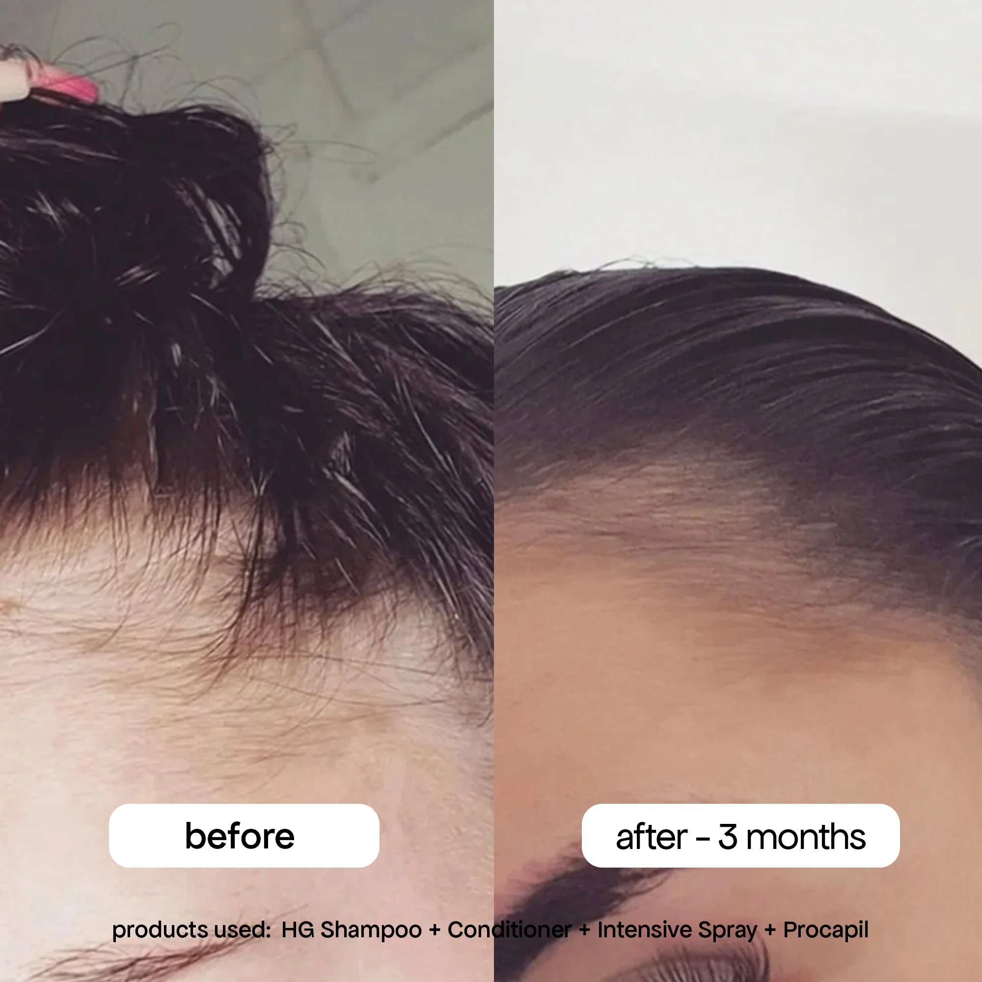ANTI-THINNING PROCAPIL® SCALP TONIC - Image 10